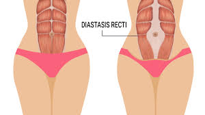 Abdominal Muscle Separation (Diastisis Recti)