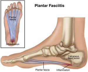 Plantar Fasciitis