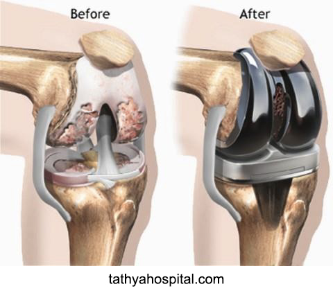 Comparison of knee before and after knee replacement surgery