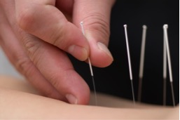 Professional Rehabilitation Services | Dry Needling